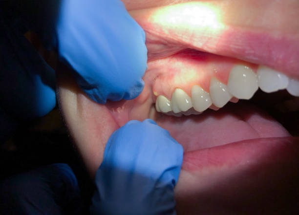 Best Chipped Tooth Repair Near Me  in Port Edwards, WI