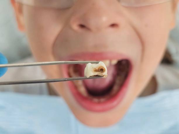 Best Broken Tooth Emergency  in Port Edwards, WI